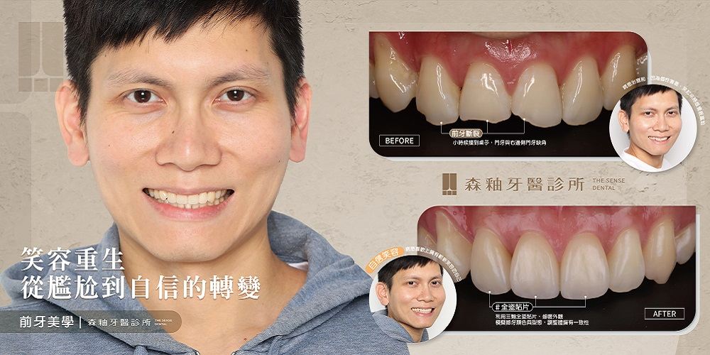 【陶瓷貼片案例分享】陶瓷貼片療程介紹、費用及注意事項說明