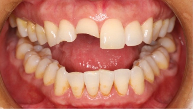 門牙斷掉如何補？5種常見修復方式