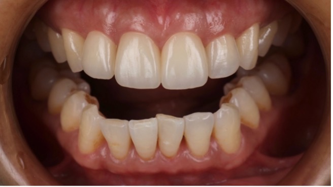 門牙斷掉如何補?5種常見修復方式
