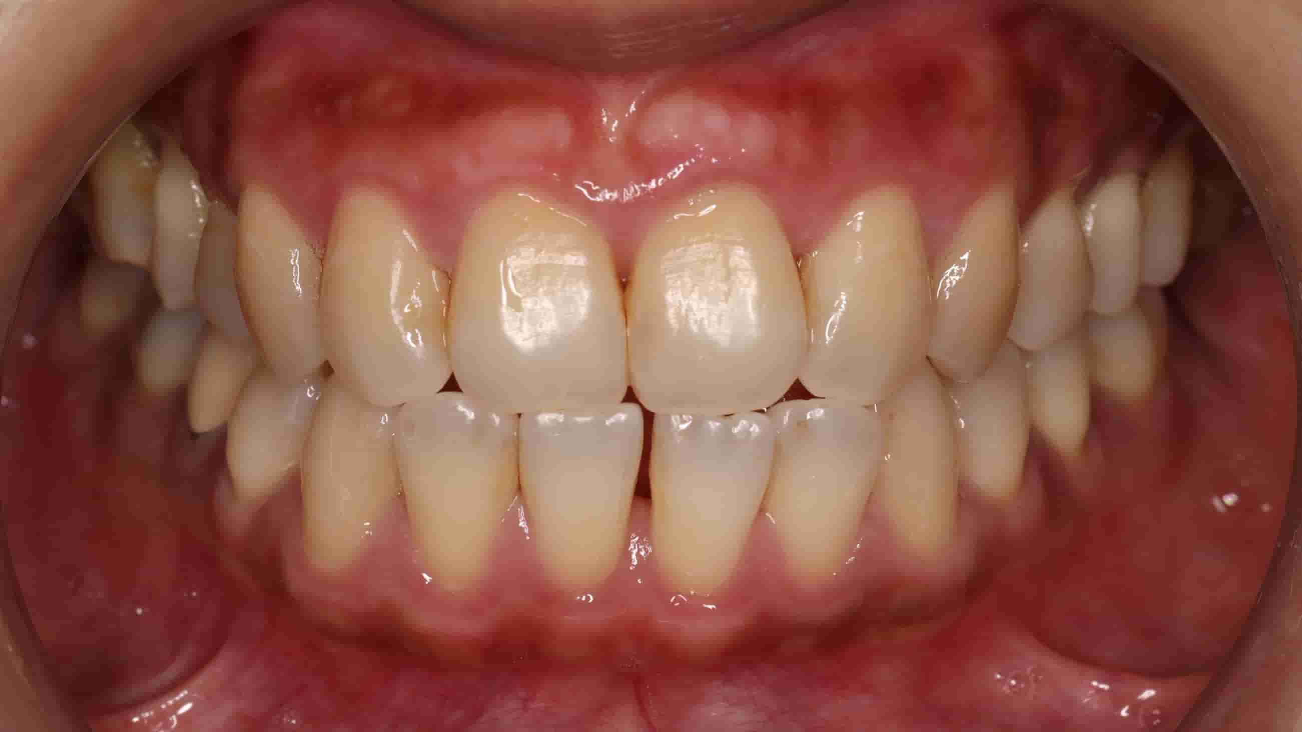 治療前牙齒外觀照