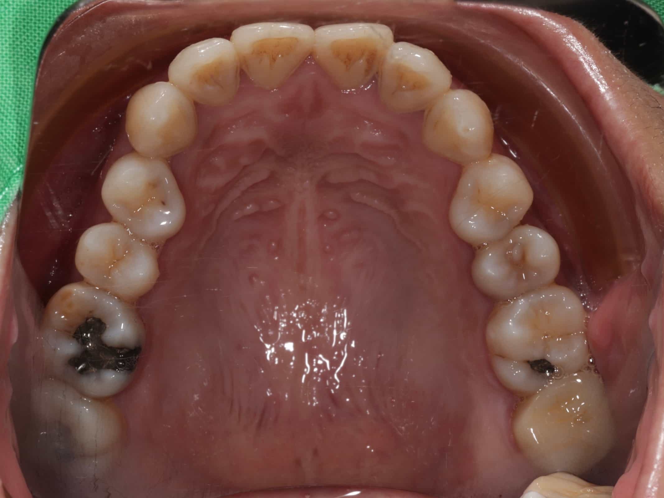 治療前上排牙齒照