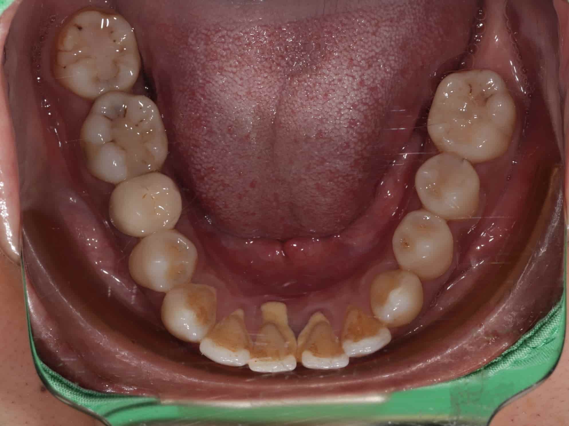 治療前下排牙齒照