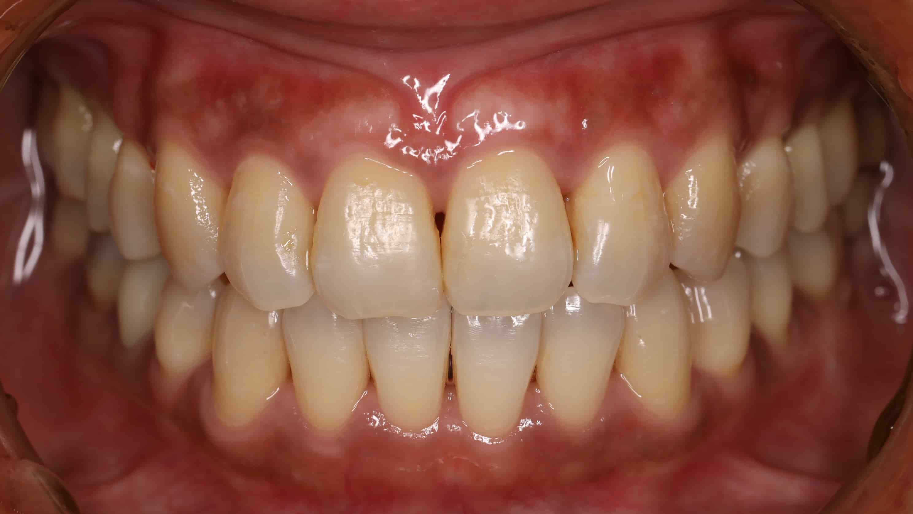 治療後牙齒外觀照