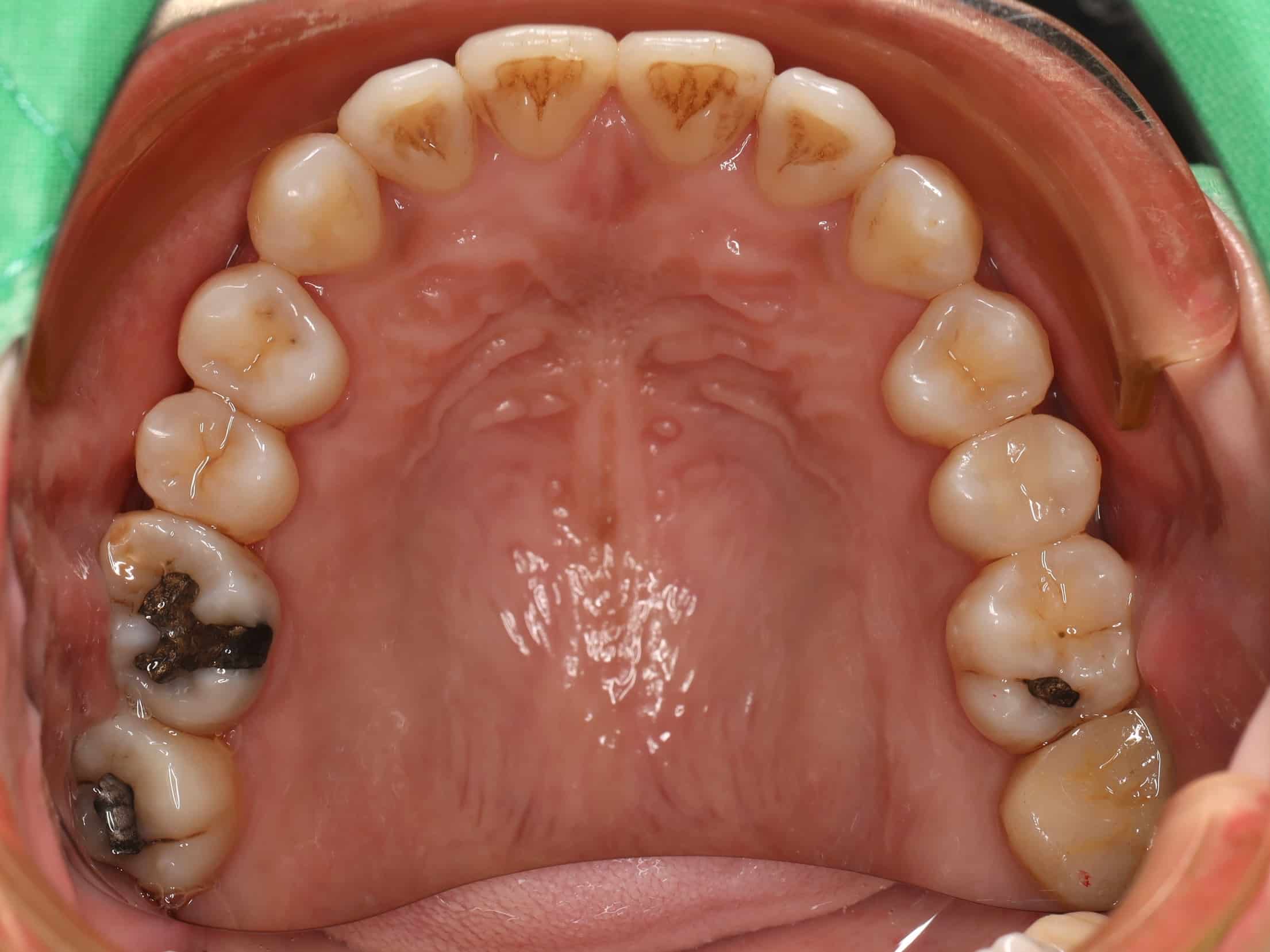 治療後上排牙齒照