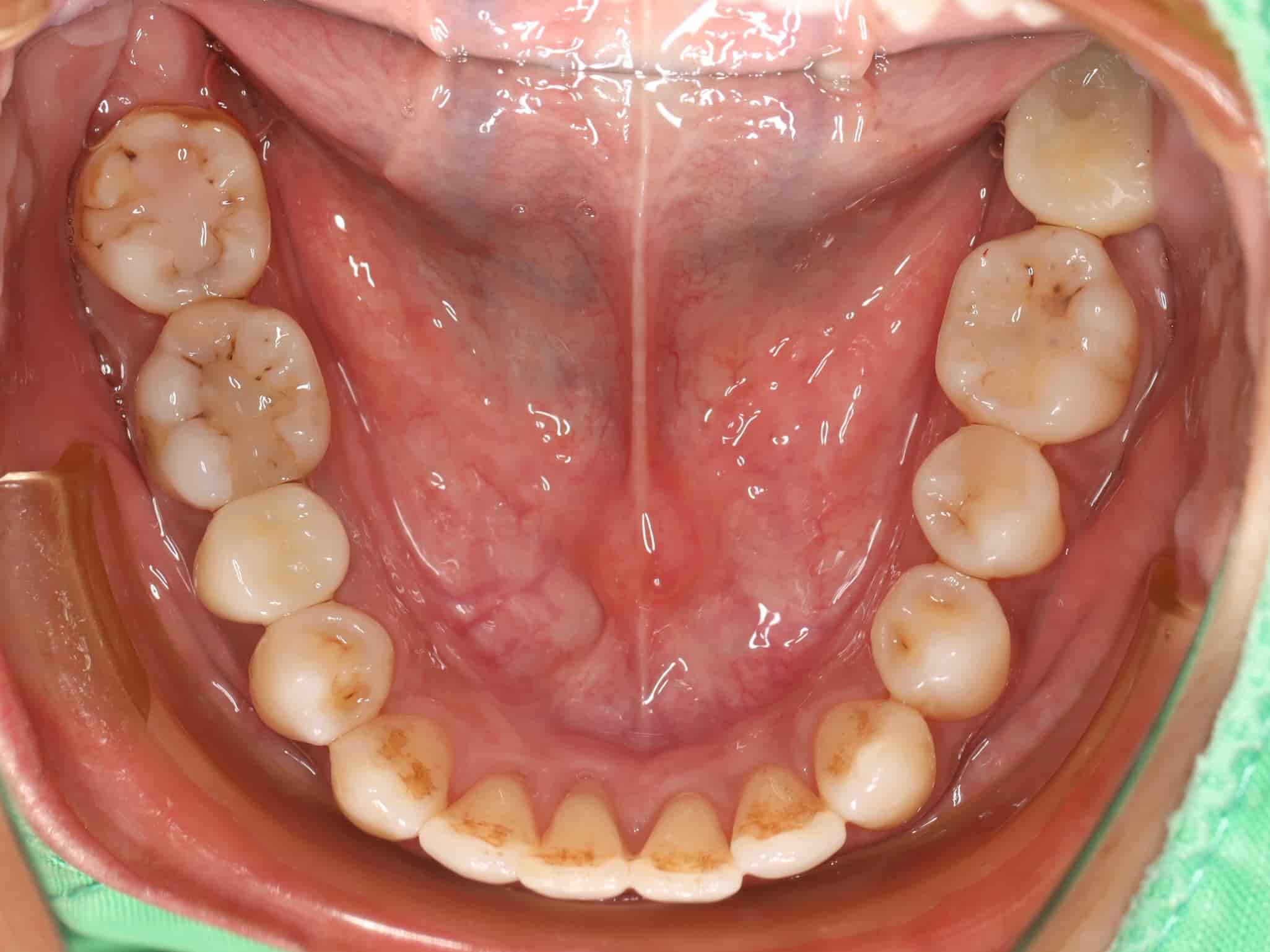 治療後下排牙齒照