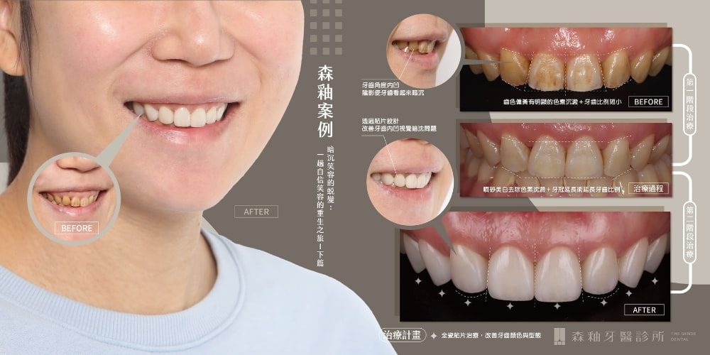 新竹牙齒美白案例|陶瓷貼片改善暗沉笑容