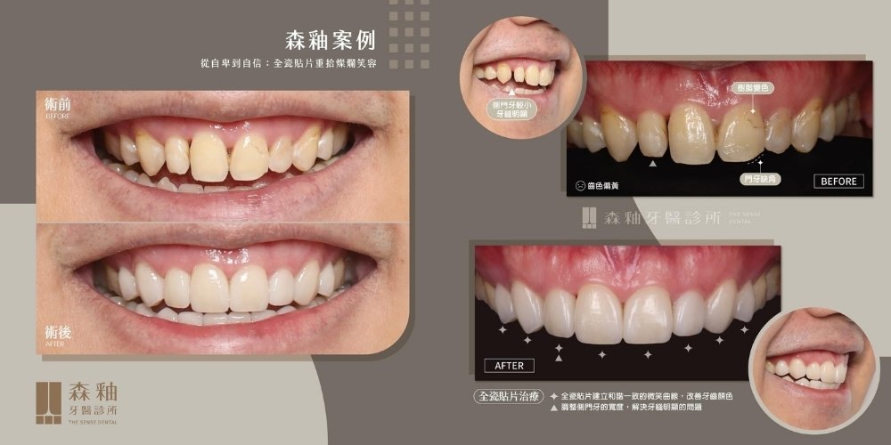 新竹牙齒美白案例|陶瓷貼片重塑自然亮白笑容