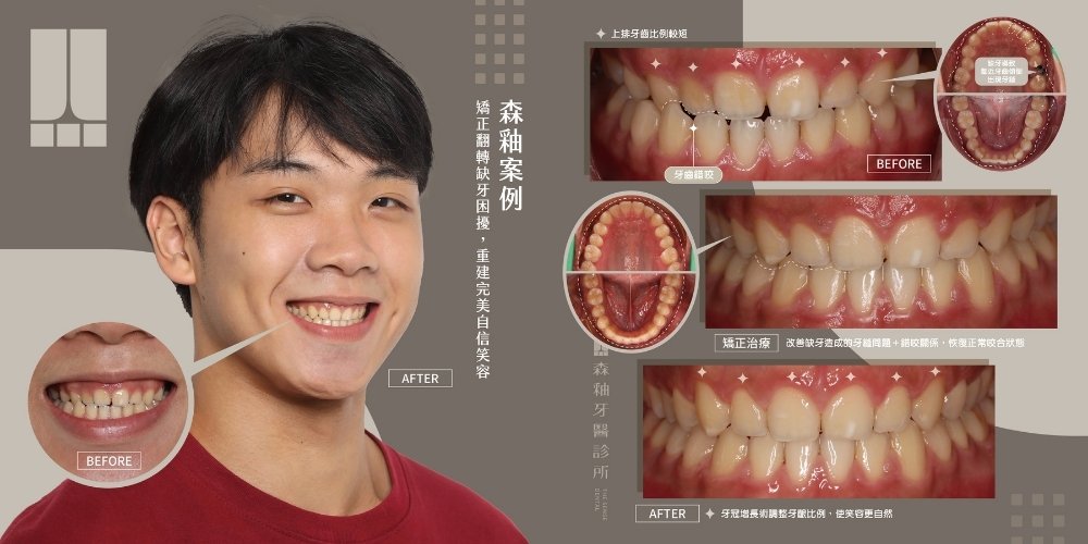 新竹隱適美案例:缺牙與錯咬也能透過矯正重建笑