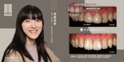 全瓷假牙案例