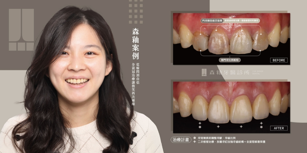 全瓷假牙前後對比圖