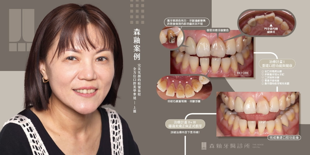 隱適美、全瓷冠治療前後圖