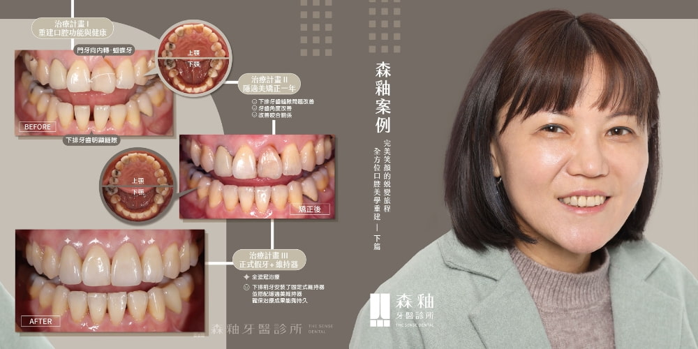 隱適美、全瓷冠前後治療圖
