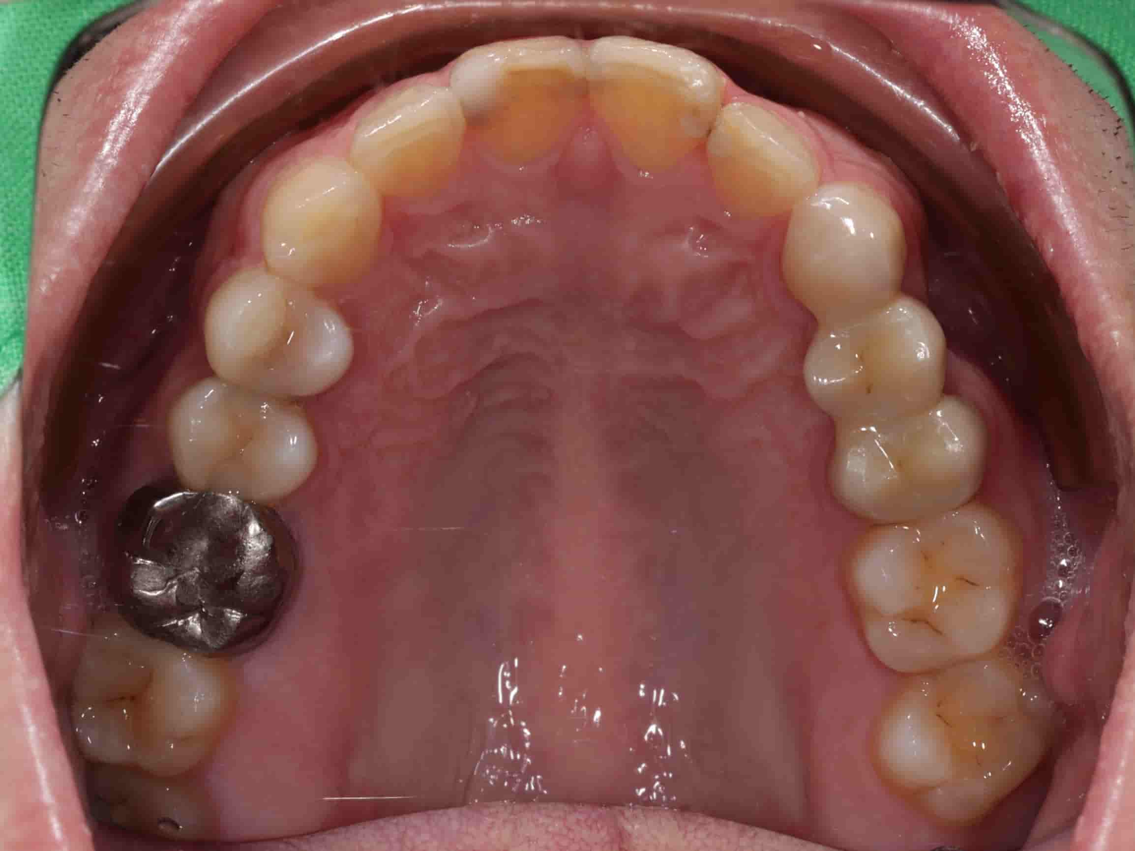 患者上排牙齒照