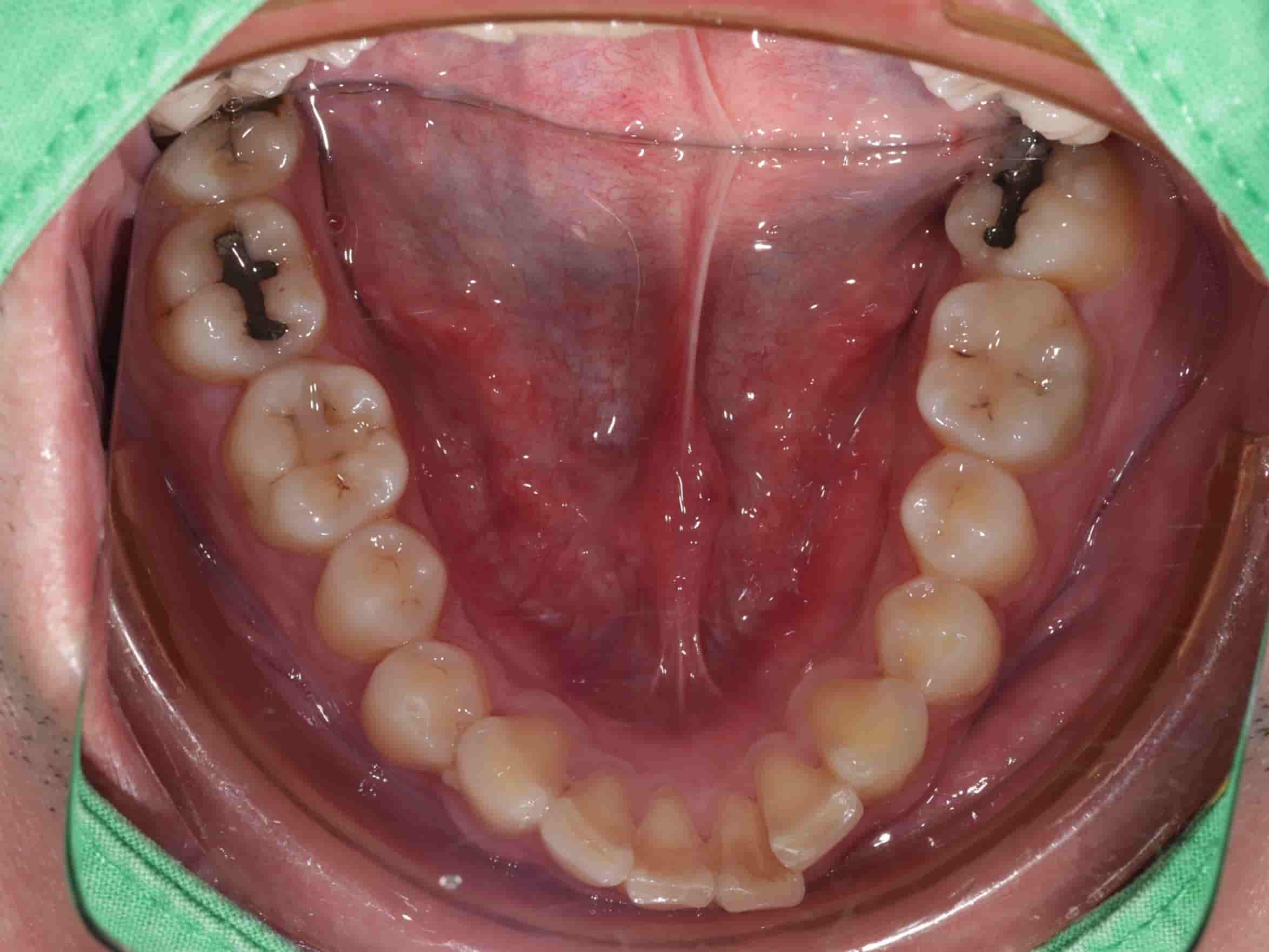 患者下排牙齒照