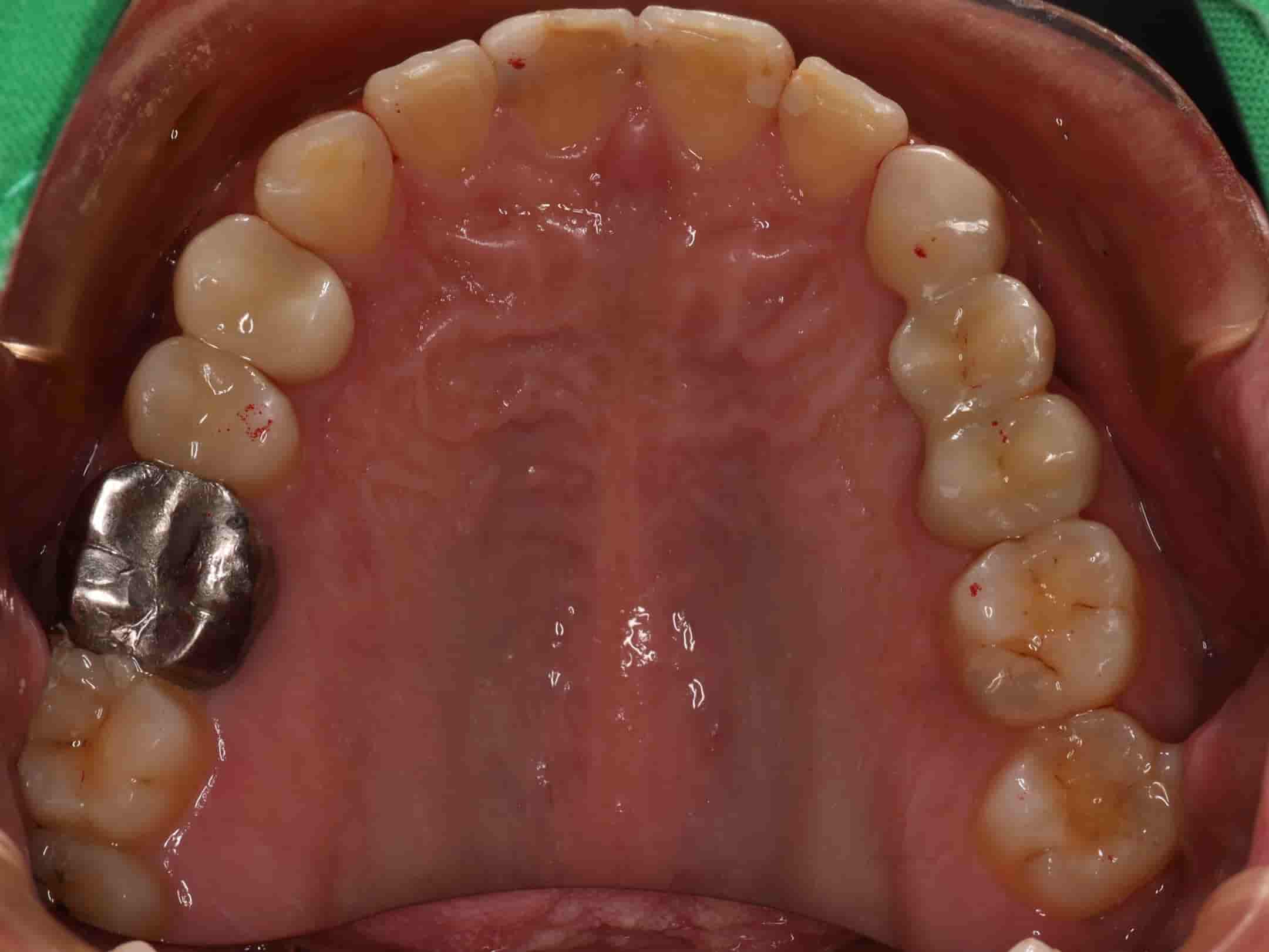 患者上排牙齒照
