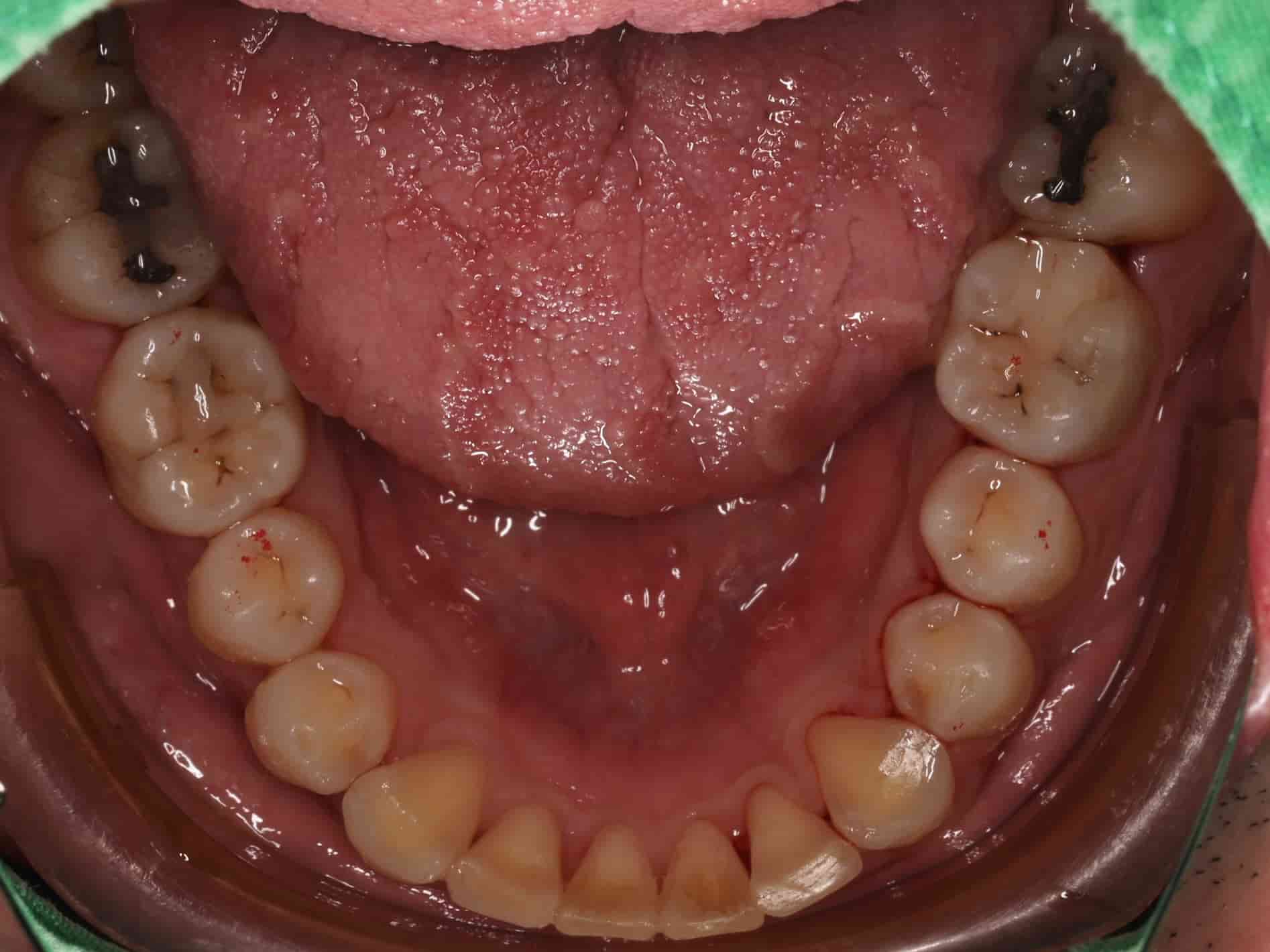 患者下排牙齒照