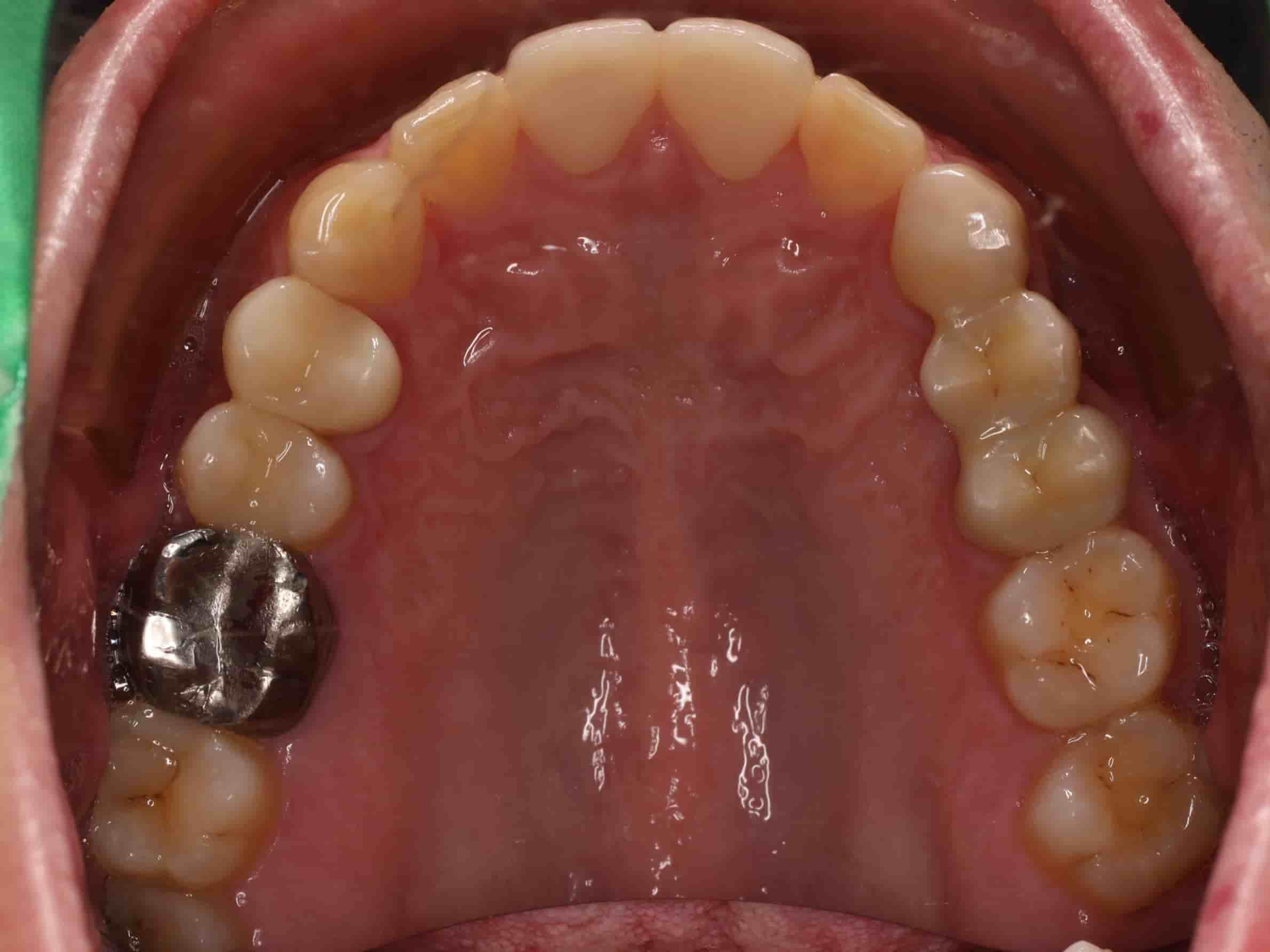 患者上排牙齒照