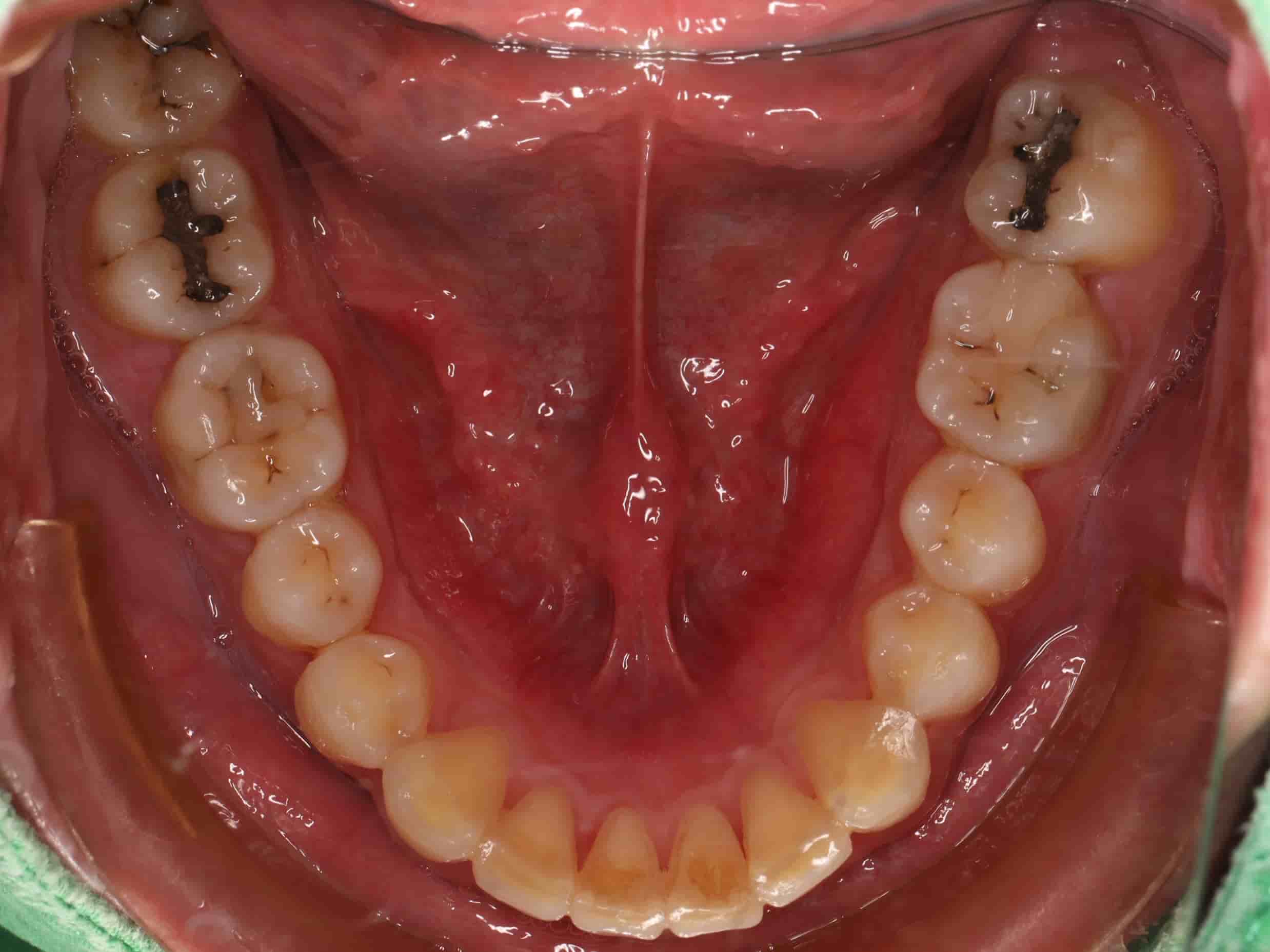 患者下排牙齒照