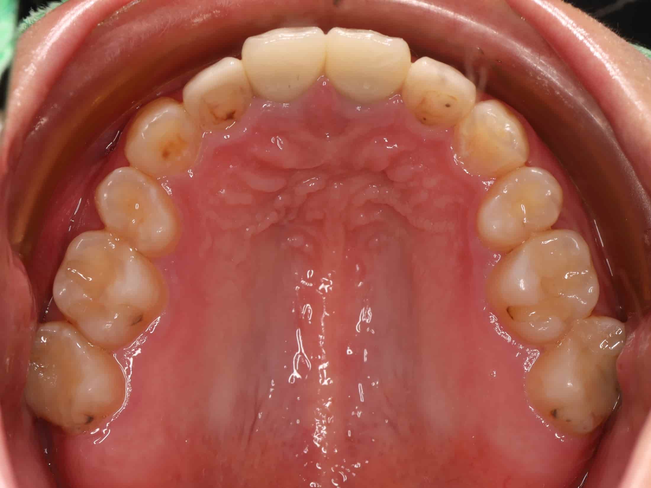 治療後上排牙齒照