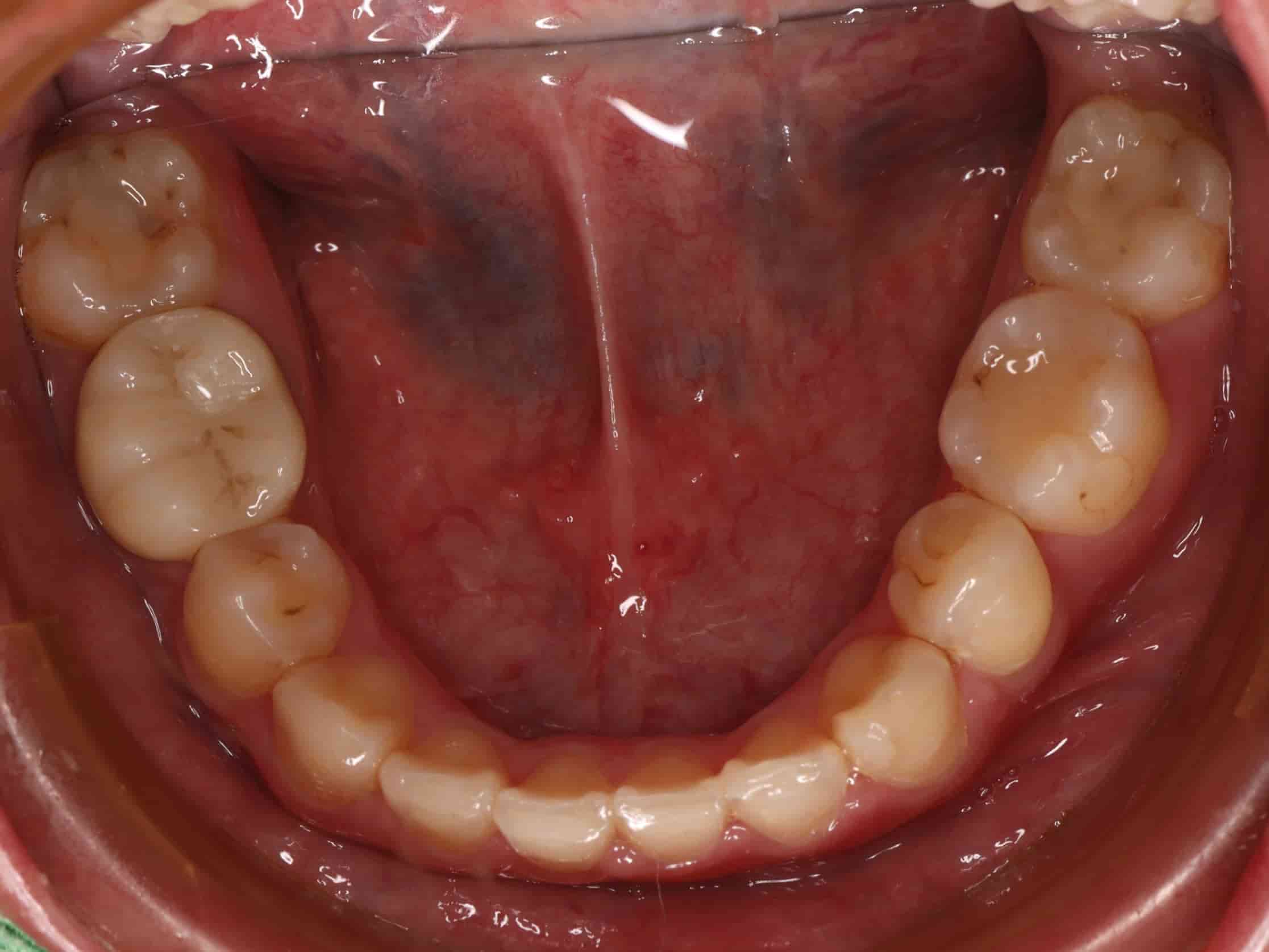 治療後下排牙齒照