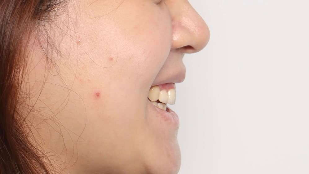 治療後牙齒側面照