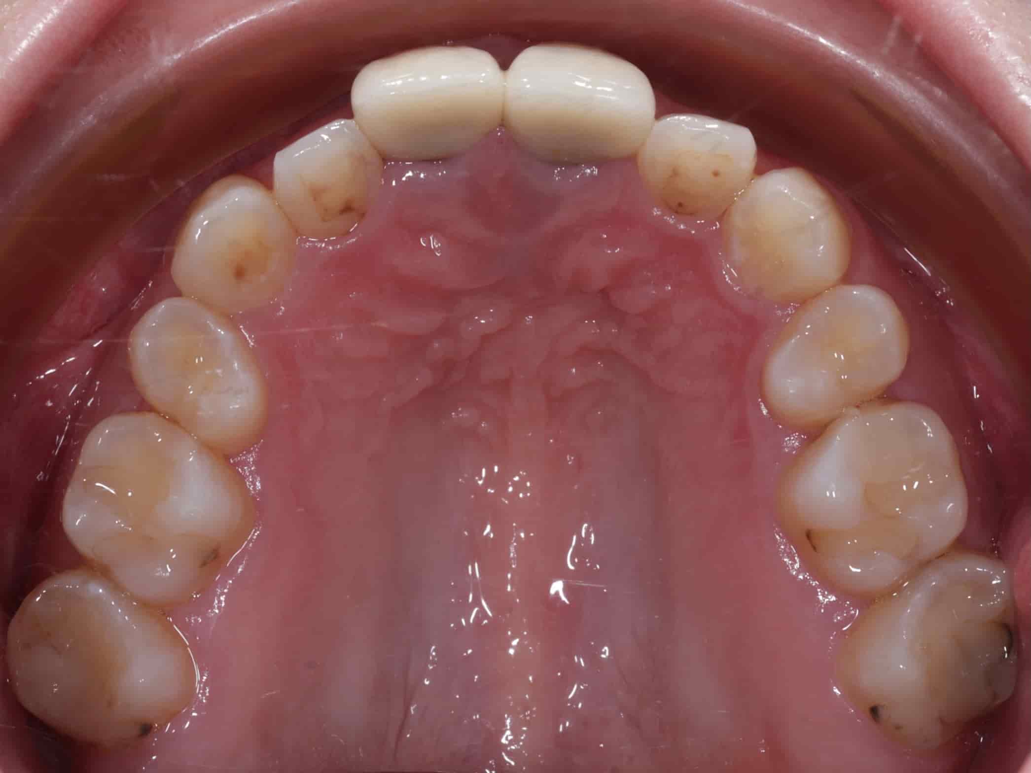 治療前上排牙齒照