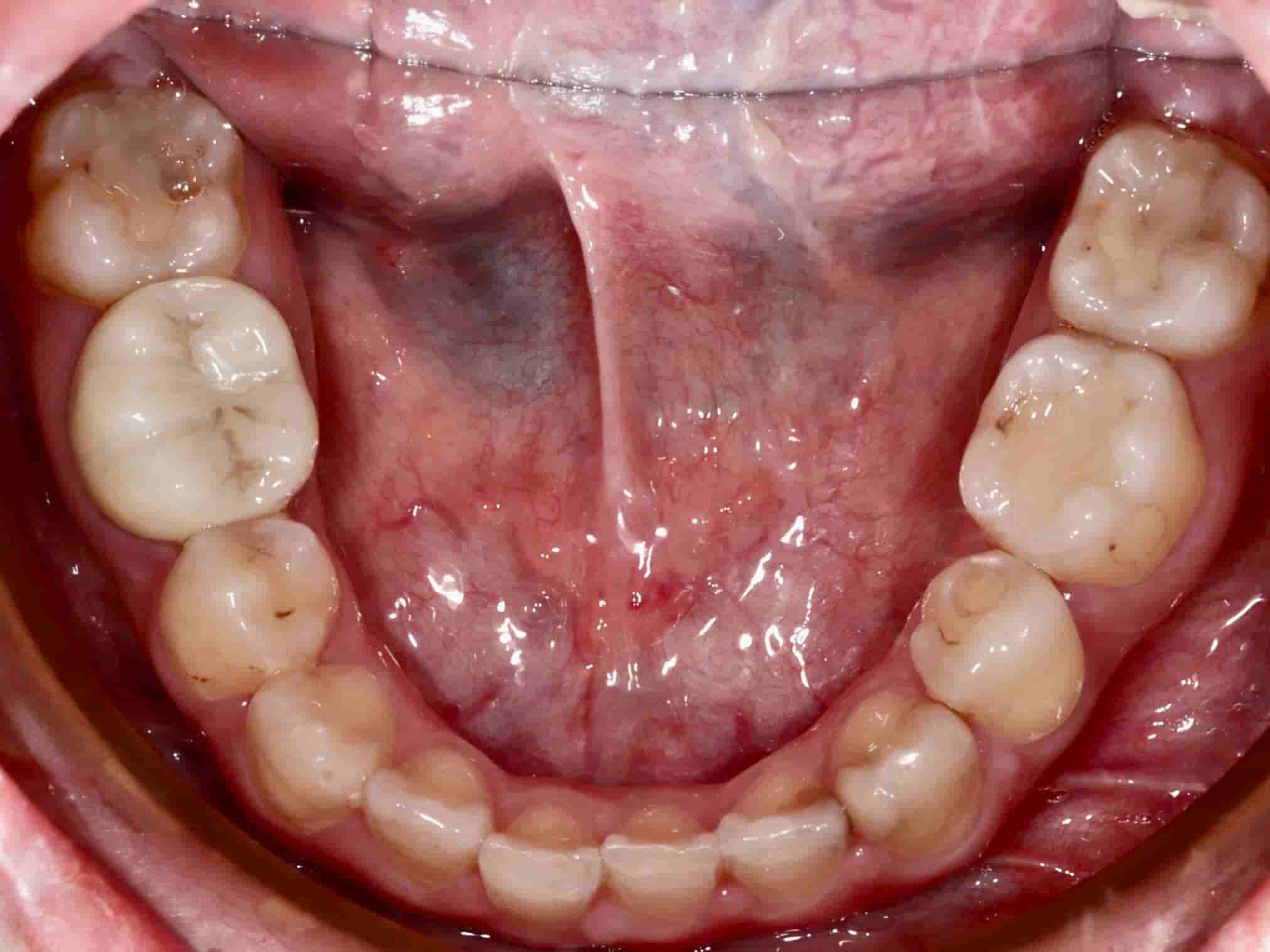 治療前下排牙齒照