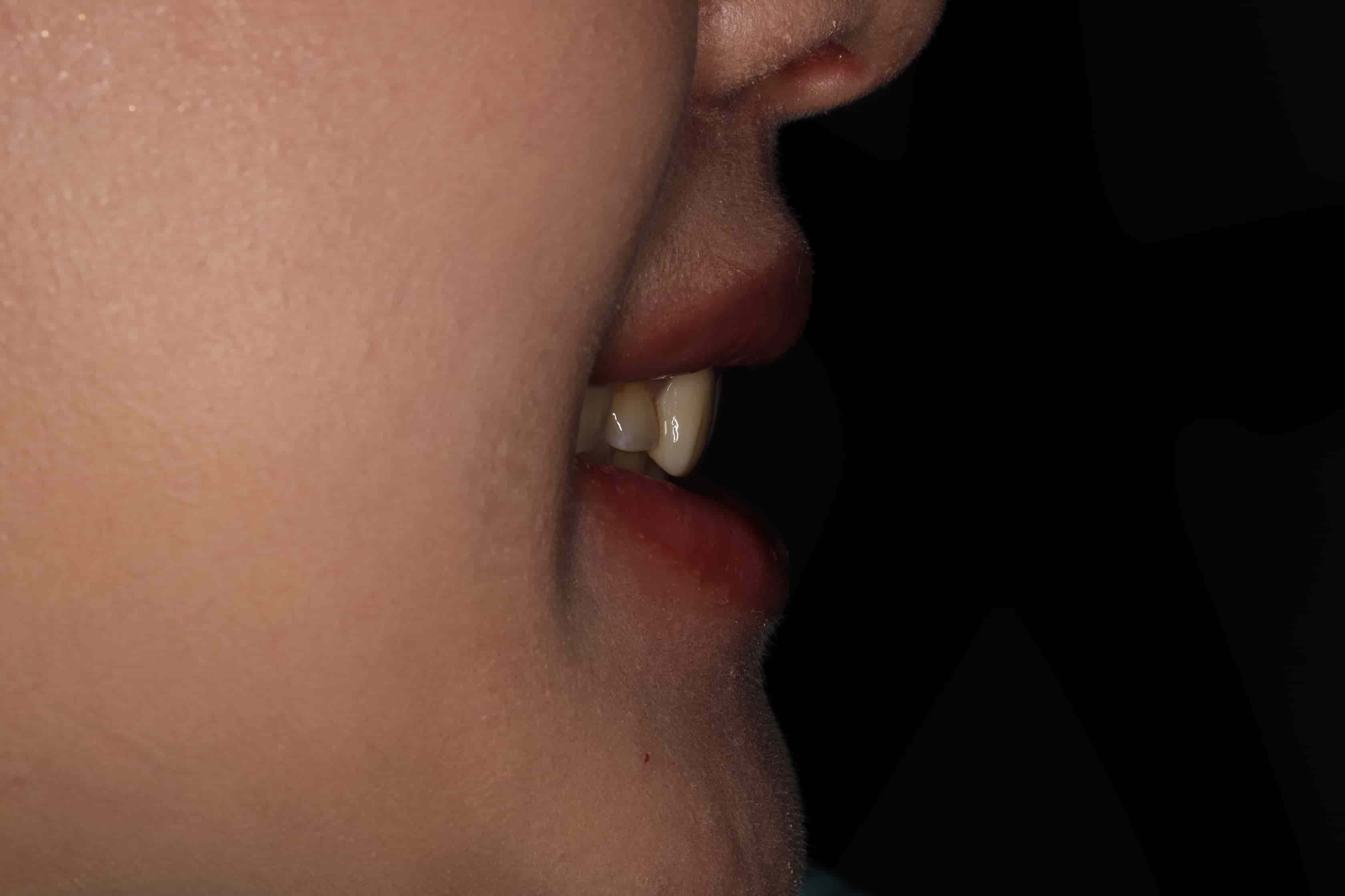 治療前側面牙齒照