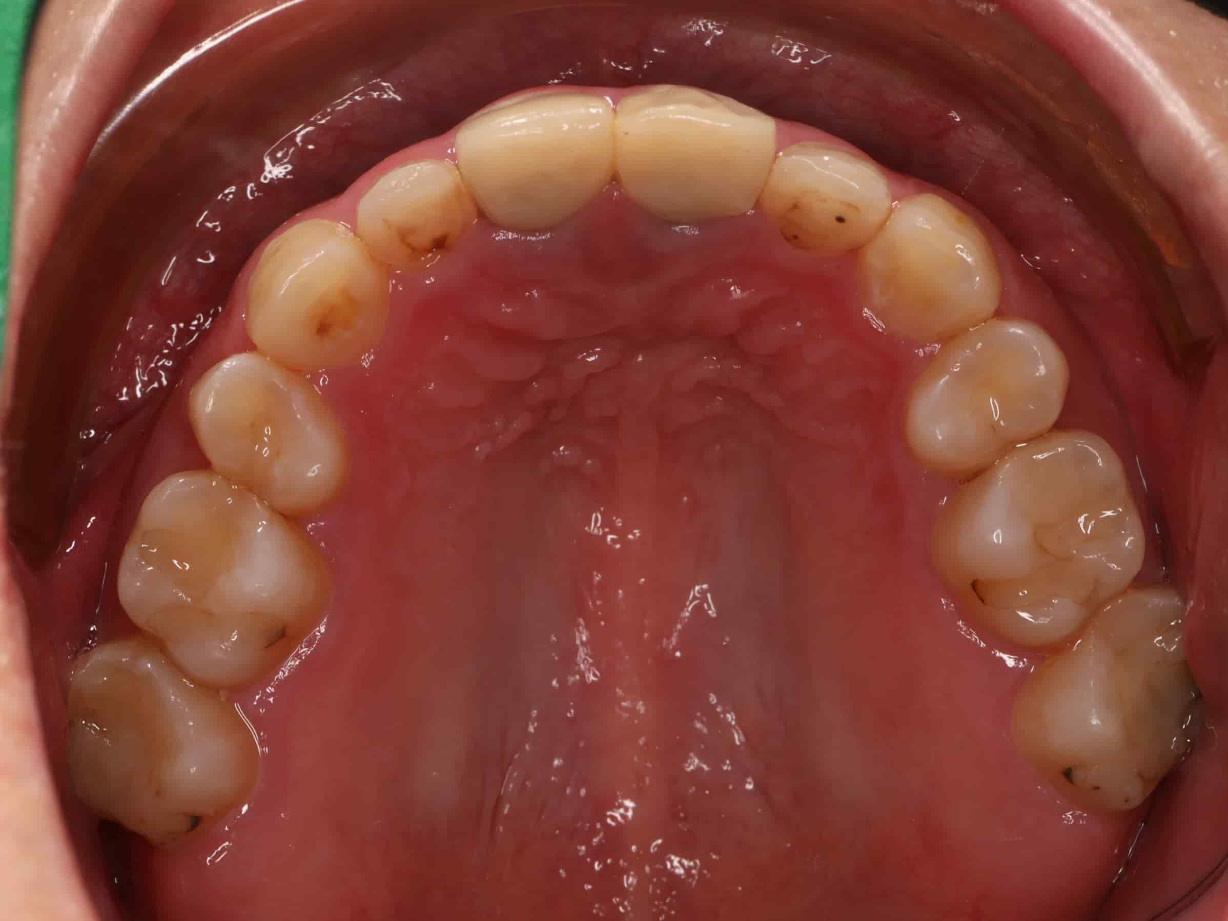 治療中上排牙齒照