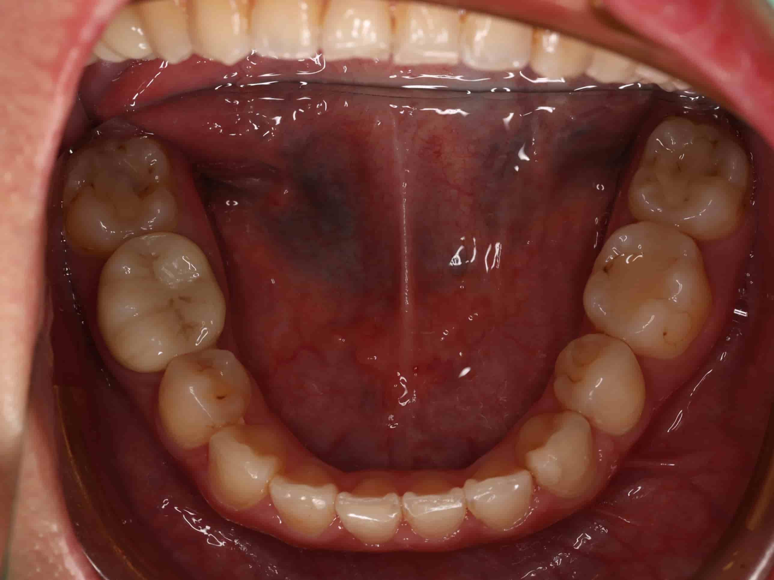 治療中下排牙齒照
