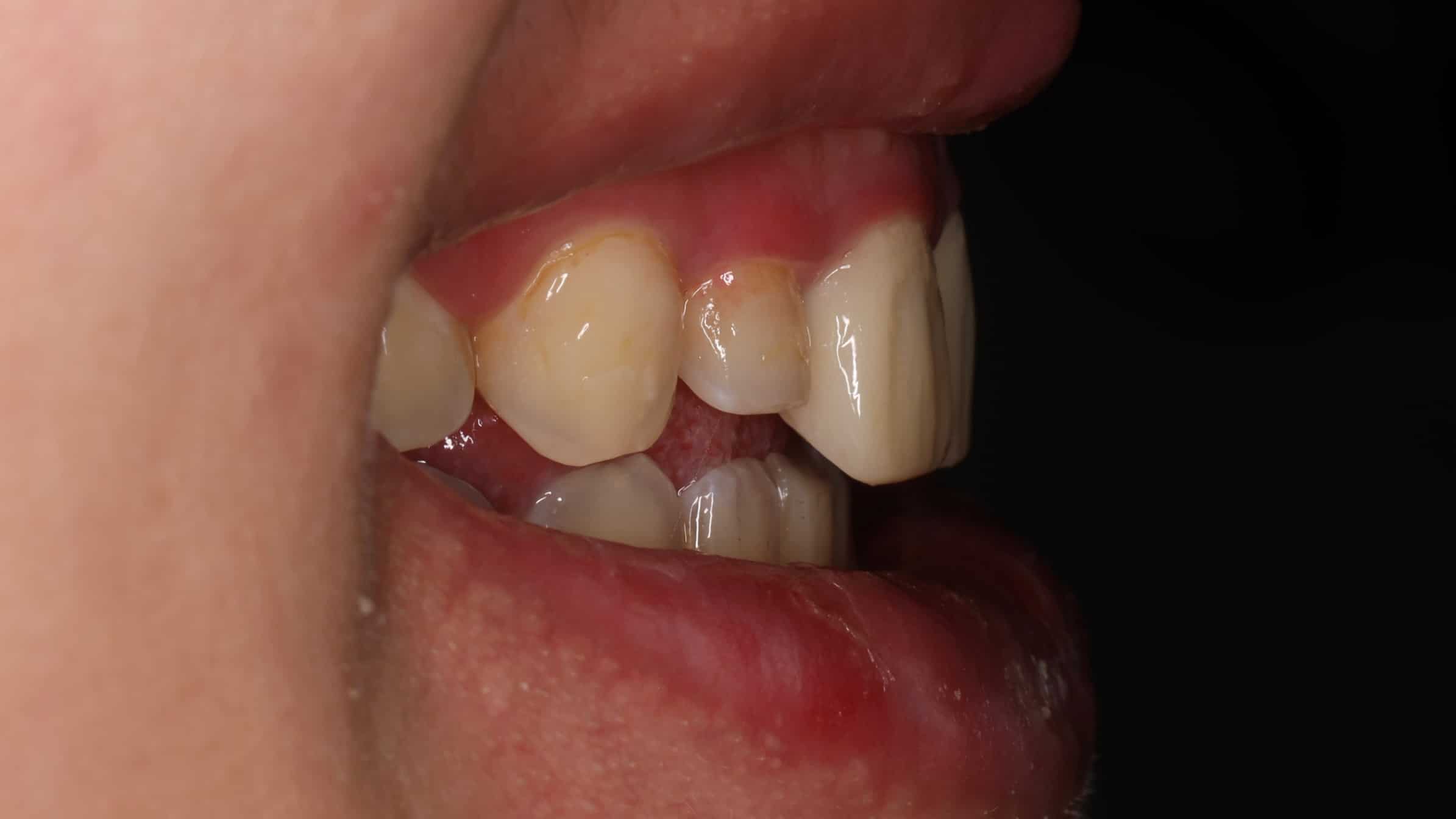 治療中側面牙齒照