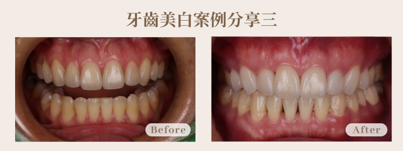 牙齒美白陶瓷貼片案例