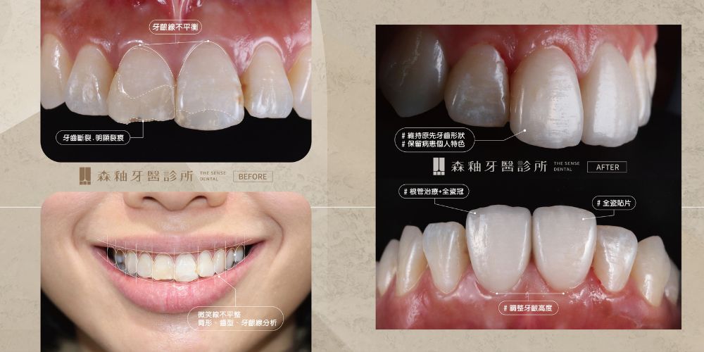 瓷牙貼片案例分享