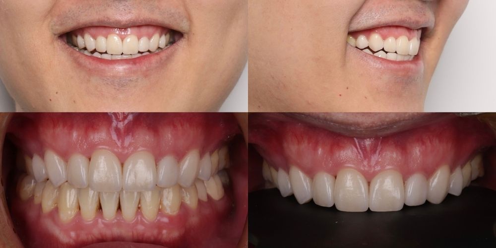 陶瓷貼片完成後:重拾笑容與生活自信