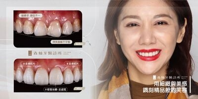 陶瓷貼片案例 _ 用細緻與美感，鐫刻精品般的笑容