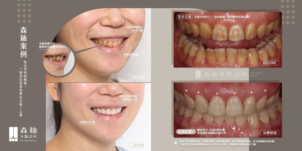 陶瓷貼片案例前後比較圖