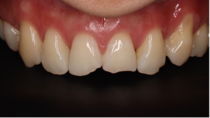 門牙斷掉如何補？5種常見修復方式