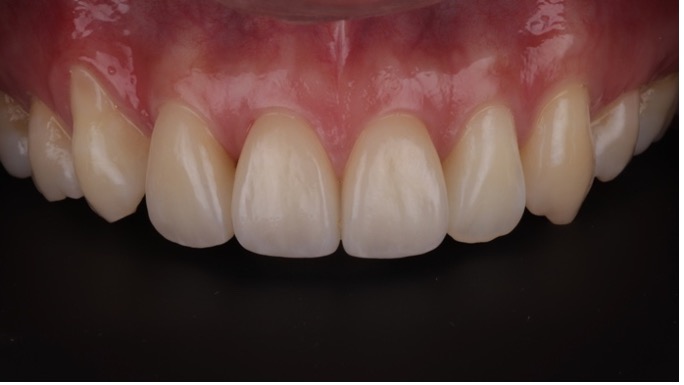 門牙斷掉如何補?5種常見修復方式