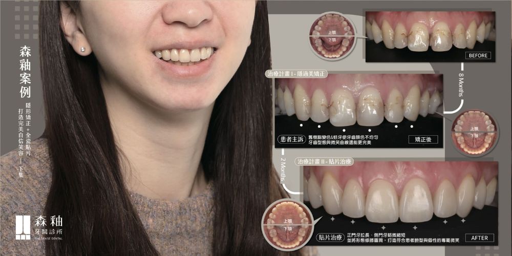 隱適美案例分享2:隱適美矯正+陶瓷貼片