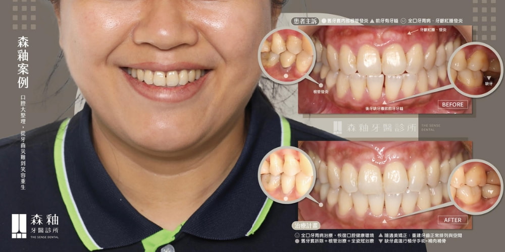 植牙成功案例分享