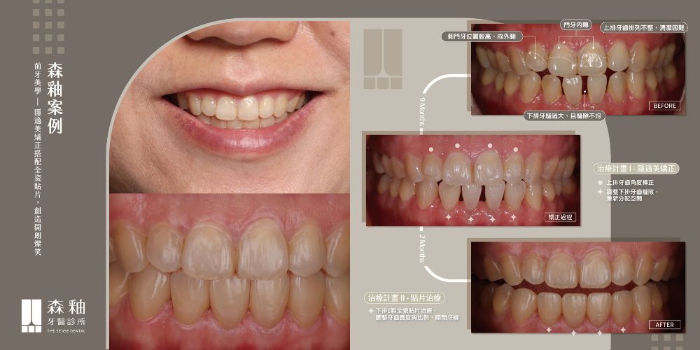 森釉牙齒矯正案例大公開：隱適美矯正+陶瓷貼片