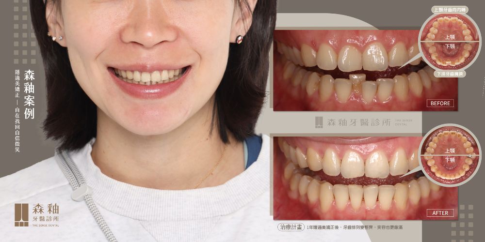 牙套矯正案例分享:隱適美牙套