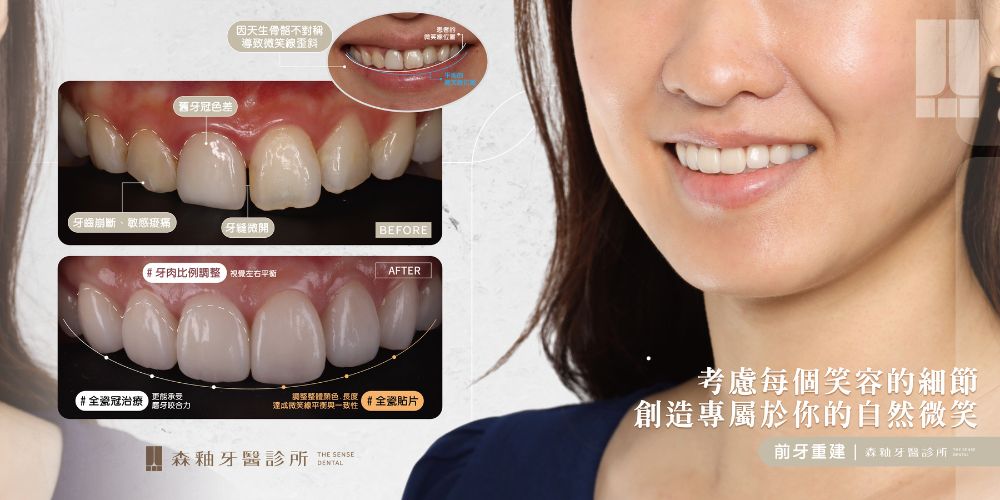 牙縫大陶瓷貼片治療案例