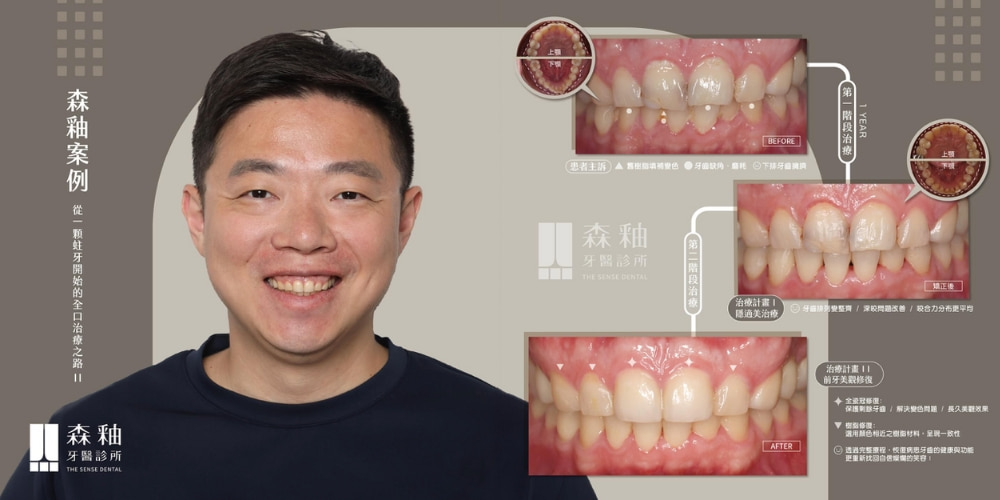 牙套矯正案例分享:告別嚴重深咬與磨牙缺角