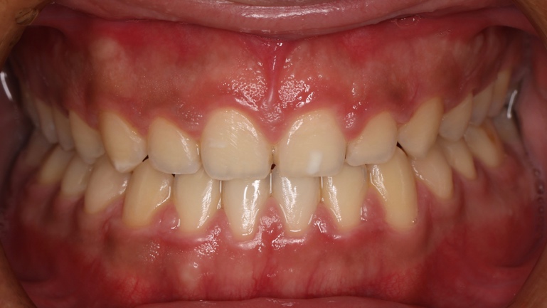牙齦組織過度覆蓋牙齒