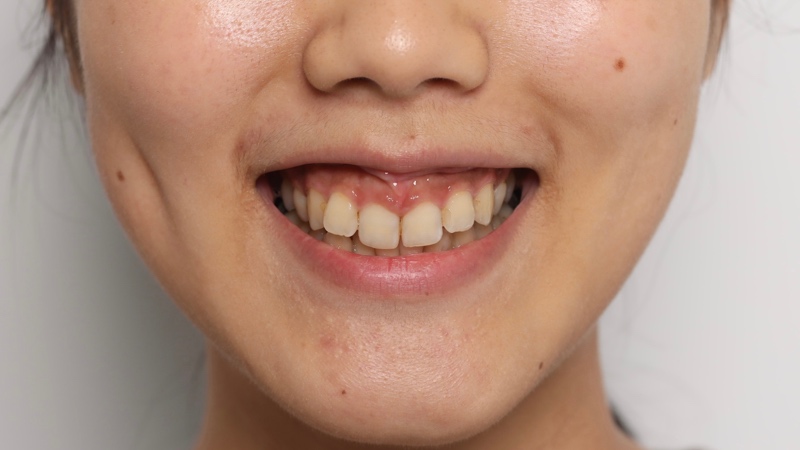 咬合不正導致笑露牙齦