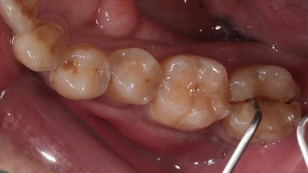 由於病患牙齒裂開導致嚴重的發炎，所以需要先拔除裂開的牙齒。