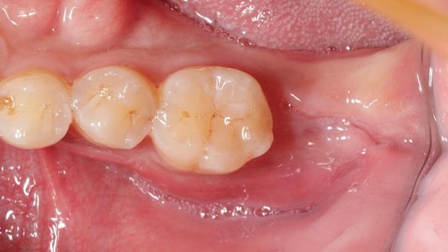 在拔除裂牙後，牙床失去支撐開始萎縮，因此需先進行補骨重建。