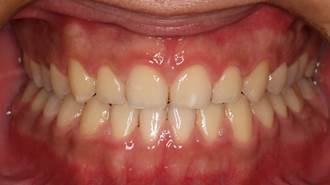 牙齦外露治療後案