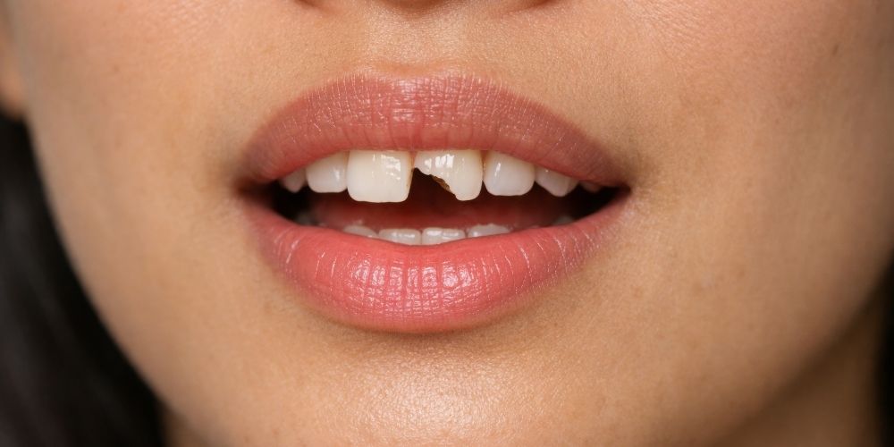 門牙斷掉怎麼辦？斷牙急救黃金步驟與治療方式、費用一次看-1